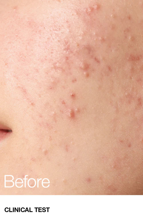 Anua Bha 2% Gentle Exfoliating Toner